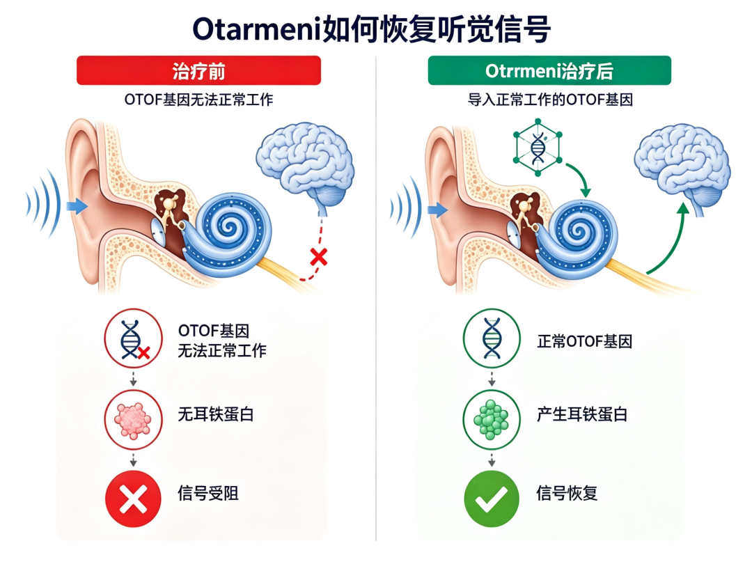 FDA 批准耳聋基因疗法!但不等于所有听力损失都能治愈